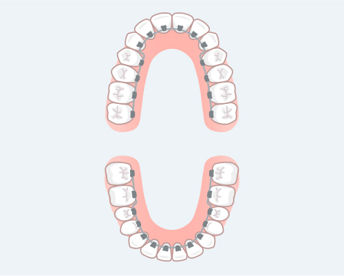 裏側矯正（舌側矯正）